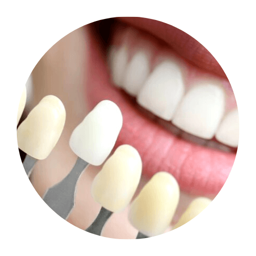 carillas dentales en las rozas de madrid