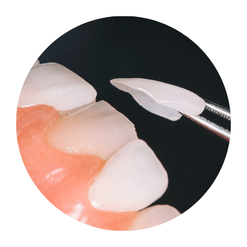 carillas esteticas en las rozas clinica dental las rozas